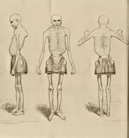 An illustration from A Living skeleton!! Authentic memoir of that singular human prodigy Claude Seurat, denominated the Living Skeleton, who arrived in London from the Continent in July, 1825. In which is contained a circumstantial detail of his person ... together with an account of his manners, habits, etc. ... / Illustrated ... by Robert Cruikshank. (1825)