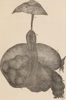 An illustration from A statistical account of the principal diseases which have occurred amongst the children admitted into the Royal Military Asylum, Chelsea, from the 1st January, 1825 to the 31st December, 1841 : with remarks and observations, together with the detail of some peculiar cases / by Samuel George Lawrance. (1842)