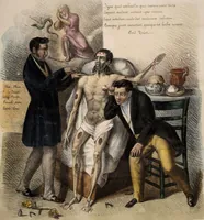 An illustration from Memoria di spontanea e singolare guarigione di un' aneurisma della femorale primitiva : osservato dalla maggior parte de' chirurgi, e medici degl' incurabili / scritta da Francesco Calise, chirurgo ordinario dell' ospedale suddetto. (1842)