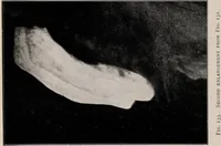 Picture 63 of 127 from Phenomena of materialisation : a contribution to the investigation of mediumistic teleplastics / by Baron von Schrenck Notzing ; translated by E.E. Fournier d'Albe. (1923), leaf 338