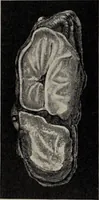 Picture 16 of 178 from A text-book of pathology / by Alfred Stengel ; with 394 illustrations in the text, many of them in colors, and 7 full-page chromolithographic plates. (1903), leaf 104