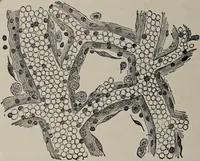 An illustration from A text-book of pathology / by Alfred Stengel ; with 394 illustrations in the text, many of them in colors, and 7 full-page chromolithographic plates. (1903)