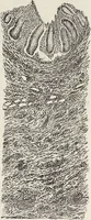 An illustration from A text-book of pathology / by Alfred Stengel ; with 394 illustrations in the text, many of them in colors, and 7 full-page chromolithographic plates. (1903)