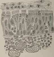 An illustration from A text-book of pathology / by Alfred Stengel ; with 394 illustrations in the text, many of them in colors, and 7 full-page chromolithographic plates. (1903)