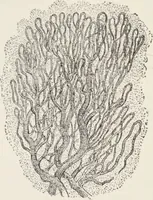 An illustration from A text-book of pathology / by Alfred Stengel ; with 394 illustrations in the text, many of them in colors, and 7 full-page chromolithographic plates. (1903)
