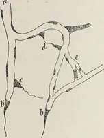 An illustration from A text-book of pathology / by Alfred Stengel ; with 394 illustrations in the text, many of them in colors, and 7 full-page chromolithographic plates. (1903)