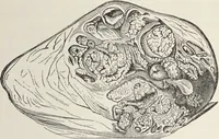 An illustration from A text-book of pathology / by Alfred Stengel ; with 394 illustrations in the text, many of them in colors, and 7 full-page chromolithographic plates. (1903)