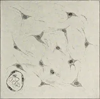 An illustration from A text-book of pathology / by Alfred Stengel ; with 394 illustrations in the text, many of them in colors, and 7 full-page chromolithographic plates. (1903)