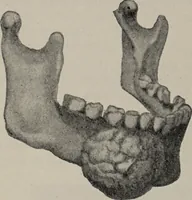 An illustration from A text-book of pathology / by Alfred Stengel ; with 394 illustrations in the text, many of them in colors, and 7 full-page chromolithographic plates. (1903)
