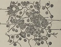 An illustration from A text-book of pathology / by Alfred Stengel ; with 394 illustrations in the text, many of them in colors, and 7 full-page chromolithographic plates. (1903)