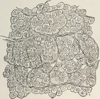 An illustration from A text-book of pathology / by Alfred Stengel ; with 394 illustrations in the text, many of them in colors, and 7 full-page chromolithographic plates. (1903)