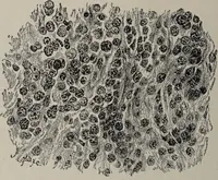An illustration from A text-book of pathology / by Alfred Stengel ; with 394 illustrations in the text, many of them in colors, and 7 full-page chromolithographic plates. (1903)