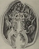 An illustration from A text-book of pathology / by Alfred Stengel ; with 394 illustrations in the text, many of them in colors, and 7 full-page chromolithographic plates. (1903)