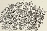 An illustration from A text-book of pathology / by Alfred Stengel ; with 394 illustrations in the text, many of them in colors, and 7 full-page chromolithographic plates. (1903)