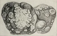 An illustration from A text-book of pathology / by Alfred Stengel ; with 394 illustrations in the text, many of them in colors, and 7 full-page chromolithographic plates. (1903)