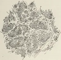 An illustration from A text-book of pathology / by Alfred Stengel ; with 394 illustrations in the text, many of them in colors, and 7 full-page chromolithographic plates. (1903)
