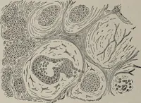 An illustration from A text-book of pathology / by Alfred Stengel ; with 394 illustrations in the text, many of them in colors, and 7 full-page chromolithographic plates. (1903)