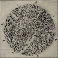 An illustration from A text-book of pathology / by Alfred Stengel ; with 394 illustrations in the text, many of them in colors, and 7 full-page chromolithographic plates. (1903)