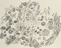 An illustration from A text-book of pathology / by Alfred Stengel ; with 394 illustrations in the text, many of them in colors, and 7 full-page chromolithographic plates. (1903)