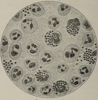 An illustration from A text-book of pathology / by Alfred Stengel ; with 394 illustrations in the text, many of them in colors, and 7 full-page chromolithographic plates. (1903)