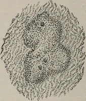 An illustration from A text-book of pathology / by Alfred Stengel ; with 394 illustrations in the text, many of them in colors, and 7 full-page chromolithographic plates. (1903)