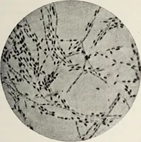 An illustration from A text-book of pathology / by Alfred Stengel ; with 394 illustrations in the text, many of them in colors, and 7 full-page chromolithographic plates. (1903)
