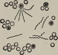 An illustration from A text-book of pathology / by Alfred Stengel ; with 394 illustrations in the text, many of them in colors, and 7 full-page chromolithographic plates. (1903)