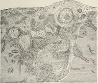 An illustration from A text-book of pathology / by Alfred Stengel ; with 394 illustrations in the text, many of them in colors, and 7 full-page chromolithographic plates. (1903)
