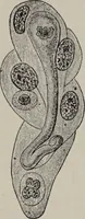 An illustration from A text-book of pathology / by Alfred Stengel ; with 394 illustrations in the text, many of them in colors, and 7 full-page chromolithographic plates. (1903)