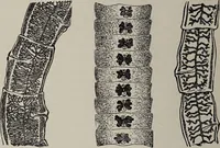 An illustration from A text-book of pathology / by Alfred Stengel ; with 394 illustrations in the text, many of them in colors, and 7 full-page chromolithographic plates. (1903)