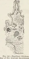 Picture 71 of 178 from A text-book of pathology / by Alfred Stengel ; with 394 illustrations in the text, many of them in colors, and 7 full-page chromolithographic plates. (1903), leaf 337