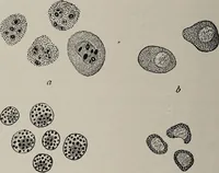 An illustration from A text-book of pathology / by Alfred Stengel ; with 394 illustrations in the text, many of them in colors, and 7 full-page chromolithographic plates. (1903)
