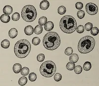 An illustration from A text-book of pathology / by Alfred Stengel ; with 394 illustrations in the text, many of them in colors, and 7 full-page chromolithographic plates. (1903)
