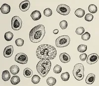 An illustration from A text-book of pathology / by Alfred Stengel ; with 394 illustrations in the text, many of them in colors, and 7 full-page chromolithographic plates. (1903)
