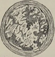 An illustration from A text-book of pathology / by Alfred Stengel ; with 394 illustrations in the text, many of them in colors, and 7 full-page chromolithographic plates. (1903)