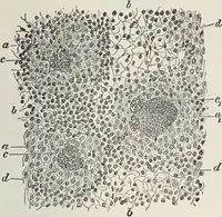An illustration from A text-book of pathology / by Alfred Stengel ; with 394 illustrations in the text, many of them in colors, and 7 full-page chromolithographic plates. (1903)