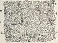 An illustration from A text-book of pathology / by Alfred Stengel ; with 394 illustrations in the text, many of them in colors, and 7 full-page chromolithographic plates. (1903)