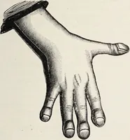 An illustration from A text-book of pathology / by Alfred Stengel ; with 394 illustrations in the text, many of them in colors, and 7 full-page chromolithographic plates. (1903)