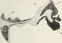 Picture 84 of 178 from A text-book of pathology / by Alfred Stengel ; with 394 illustrations in the text, many of them in colors, and 7 full-page chromolithographic plates. (1903), leaf 399