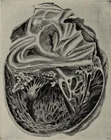 An illustration from A text-book of pathology / by Alfred Stengel ; with 394 illustrations in the text, many of them in colors, and 7 full-page chromolithographic plates. (1903)