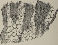 An illustration from A text-book of pathology / by Alfred Stengel ; with 394 illustrations in the text, many of them in colors, and 7 full-page chromolithographic plates. (1903)
