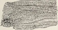 An illustration from A text-book of pathology / by Alfred Stengel ; with 394 illustrations in the text, many of them in colors, and 7 full-page chromolithographic plates. (1903)