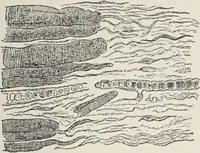 An illustration from A text-book of pathology / by Alfred Stengel ; with 394 illustrations in the text, many of them in colors, and 7 full-page chromolithographic plates. (1903)