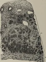 An illustration from A text-book of pathology / by Alfred Stengel ; with 394 illustrations in the text, many of them in colors, and 7 full-page chromolithographic plates. (1903)