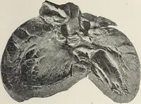 An illustration from A text-book of pathology / by Alfred Stengel ; with 394 illustrations in the text, many of them in colors, and 7 full-page chromolithographic plates. (1903)