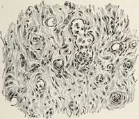 An illustration from A text-book of pathology / by Alfred Stengel ; with 394 illustrations in the text, many of them in colors, and 7 full-page chromolithographic plates. (1903)