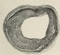 An illustration from A text-book of pathology / by Alfred Stengel ; with 394 illustrations in the text, many of them in colors, and 7 full-page chromolithographic plates. (1903)