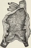Picture 96 of 178 from A text-book of pathology / by Alfred Stengel ; with 394 illustrations in the text, many of them in colors, and 7 full-page chromolithographic plates. (1903), leaf 437