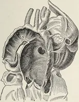 An illustration from A text-book of pathology / by Alfred Stengel ; with 394 illustrations in the text, many of them in colors, and 7 full-page chromolithographic plates. (1903)