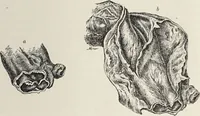 An illustration from A text-book of pathology / by Alfred Stengel ; with 394 illustrations in the text, many of them in colors, and 7 full-page chromolithographic plates. (1903)